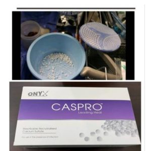 Caspro Antibiotic Beads with Preparation Kit 5cc Kit